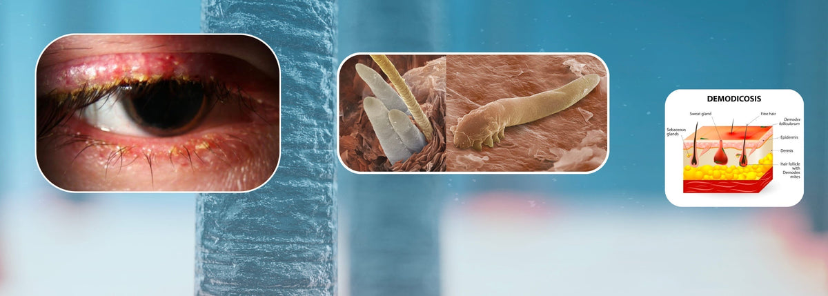 grafica con occhio malato di blefarite da demodex